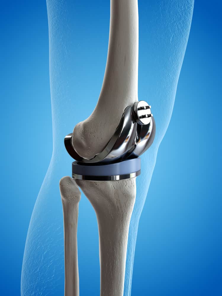 A diagram of a common knee replacement